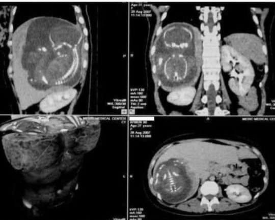 Fetus within liver!!!
#MedTwitter #MedEd #FOAMrad #radiology