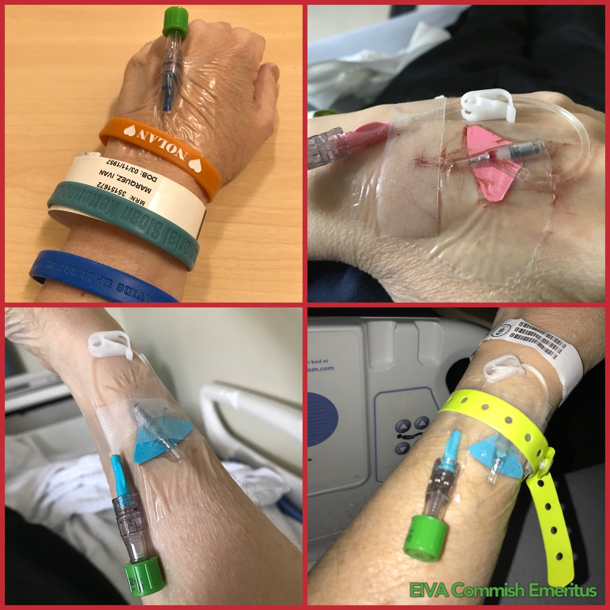 EIVACommish's tweet photo. 🥵 DaCommish Emeritus on #Day3 @MSKCancerCenter 🏥 First #InHospital stay in 17 years #FightingCancer 💪🏼 Thanks to #internet #casting ❤️ @NCAAMVB #BigBoyVolleyball 🏐 continues to provide incomparable #joy 🥰 Having #flashback of Shooter Flatch in #Hoosiers 🍿 https://t.co/YiToUYauT4