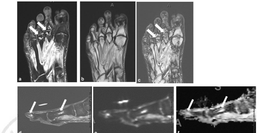 Avneesh Chhabra, MD, MBA, FACR (@achhabramd) on Twitter photo Hot off the press- Learn more about Bone Marrow Changes and Lesions of Diabetic Foot and Ankle Disease: Conventional and Advanced Magnetic Resonance Imaging <a href="/SMR_SeminarsMSK/">Seminars in Musculoskeletal Radiology</a> <a href="/gbajaj_md/">Gitanjali Bajaj</a> <a href="/UTSW_RadRes/">UTSW Radiology Residencies</a> <a href="/utswortho/">UTSW Orthopaedic Surgery</a> @Brewington_UTSW Hot off the press- Learn more about Bone Marrow Changes and Lesions of Diabetic Foot and Ankle Disease: Conventional and Advanced Magnetic Resonance Imaging <a href="/SMR_SeminarsMSK/">Seminars in Musculoskeletal Radiology</a> <a href="/gbajaj_md/">Gitanjali Bajaj</a> <a href="/UTSW_RadRes/">UTSW Radiology Residencies</a> <a href="/utswortho/">UTSW Orthopaedic Surgery</a> @Brewington_UTSW