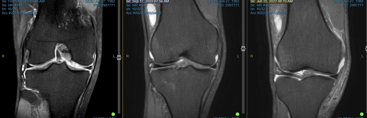 ApexPhysicians's tweet photo. ACL and MCL healing- case of non-op management- clinical stability, MRI recovery and return o full capacity work... https://t.co/bm7po2T0zR