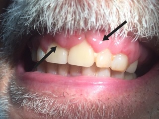 BrownJHM's tweet photo. A patient with history of seizures and hypertension presented with oral bleeding. He was recently started on a different anti-epileptic drug by his neurologist. He reported having a good dental hygiene. What is the likely culprit medication? (Image Stanford medicine) #medtwitter https://t.co/ubhbtpnvsh