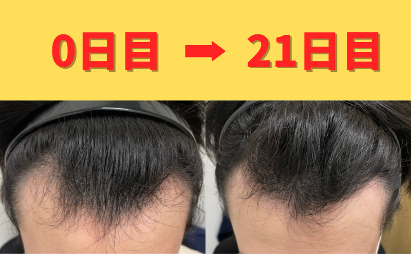 30s_aga's tweet photo. 【21日目】
経過観察で行ってきました。

飲み薬と塗り薬を毎日欠かさず続けています。
今日は初診時の採血結果と2回目の採血も行っていただきました！

契約特典の幹細胞ノーニードルで頭皮に薬を浸透？してもらったので効果が楽しみです！！

今のところ副作用もなしで髪にコシが出てきた様子😆 https://t.co/BwG6yYtqfM