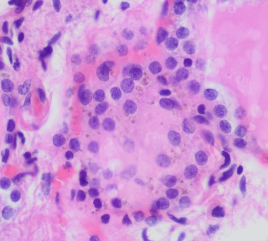 Part 4. It is a PTC, but this thread is about LIPOFUSCIN, common in normal thyroid follicular cells ⬇️
🚩Lysosomal non degradable product of oxidative stress
🚩Only seen in postmitotic and slowly dividing cells 
🚩Active proliferating cells dilute it during succesive divisions