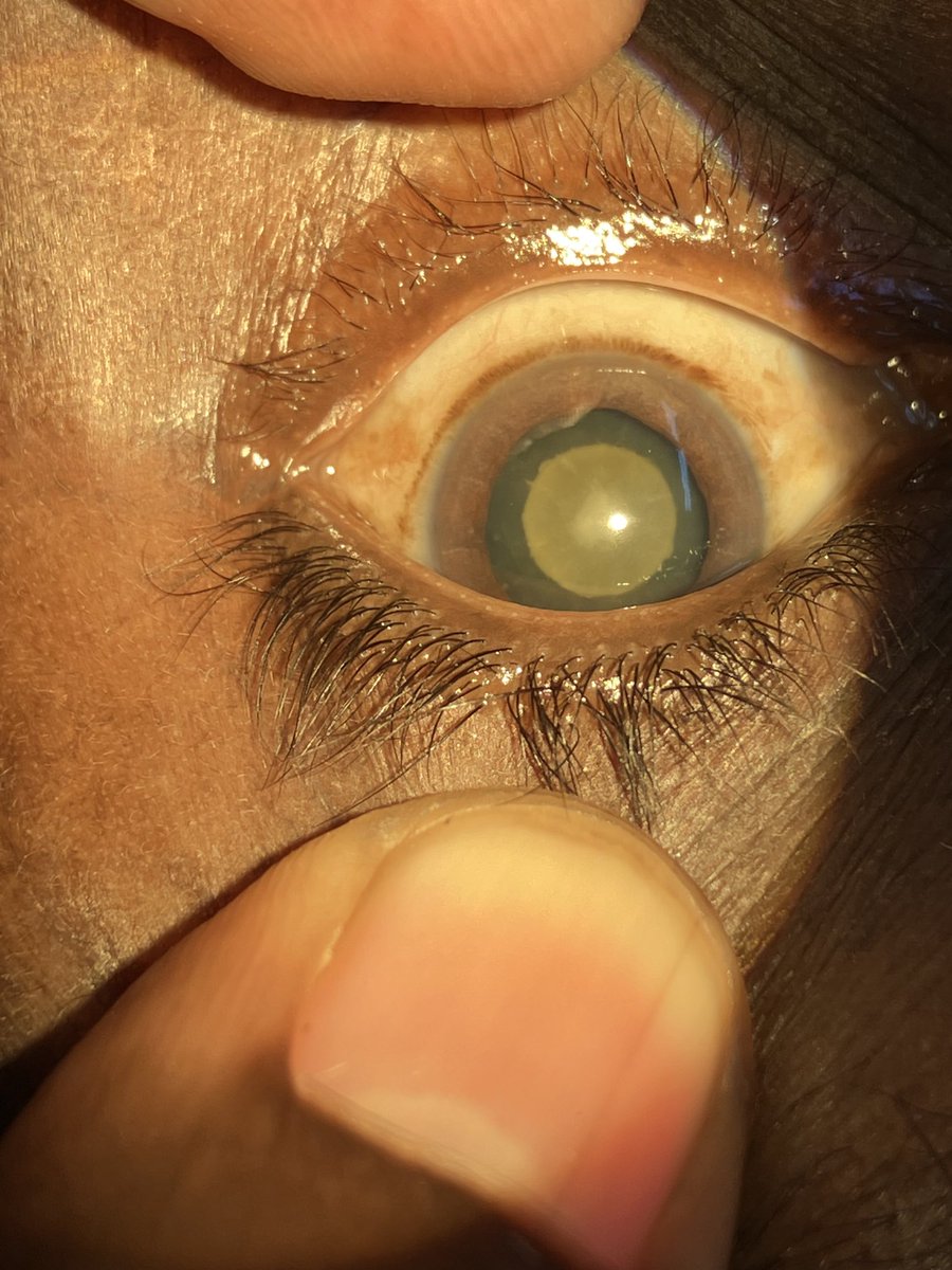 AttoGladys's tweet photo. My first patient on the operating table today had this type of congenital cataract. She’s 65 yrs. She said when she was a baby, a witch touched her eyes and that’s how she got visually impaired https://t.co/FmL8ZemfAo
