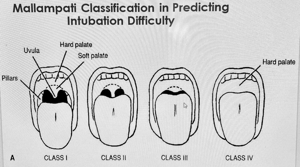 Studying Medicine on Twitter "Mallampati Classification in Predicting
