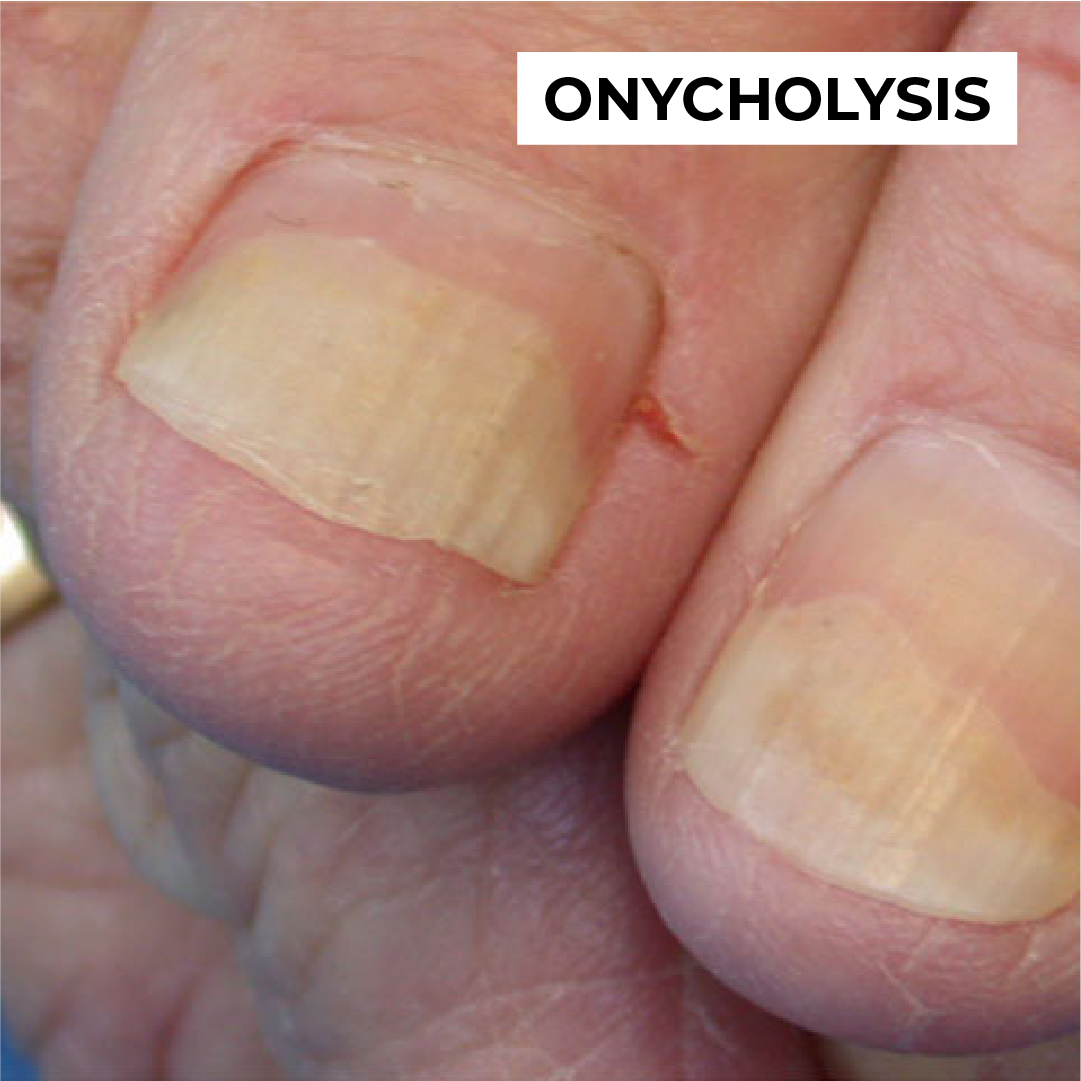 dermnetnz's tweet photo. Check out these 4 nail disorders. Want to know more? Visit DermNet for quick yet comprehensive information on all dermatological conditions.
#DermNet #naildisorders #nailhealth #nailproblems #dermatology #nailcare #medicaleducation #CPD https://t.co/Ulhn29wDfv