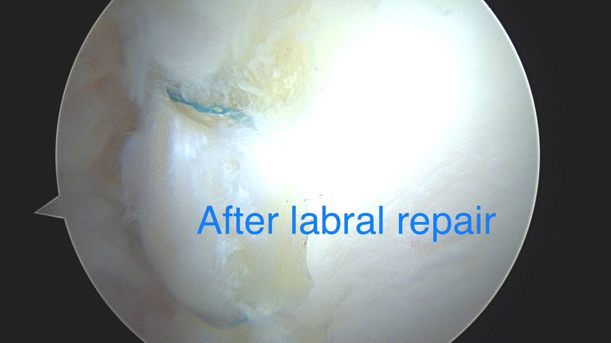 DrDerekOchiai's tweet photo. #HipArthroscopy is a great way to treat symptomatic labral tears.
PAO is a great way to treat #HipDysplasia.
Can these surgeries be done together?
Yes. Yes they can.
With @DrFarshadAdib https://t.co/M2IthxNURr