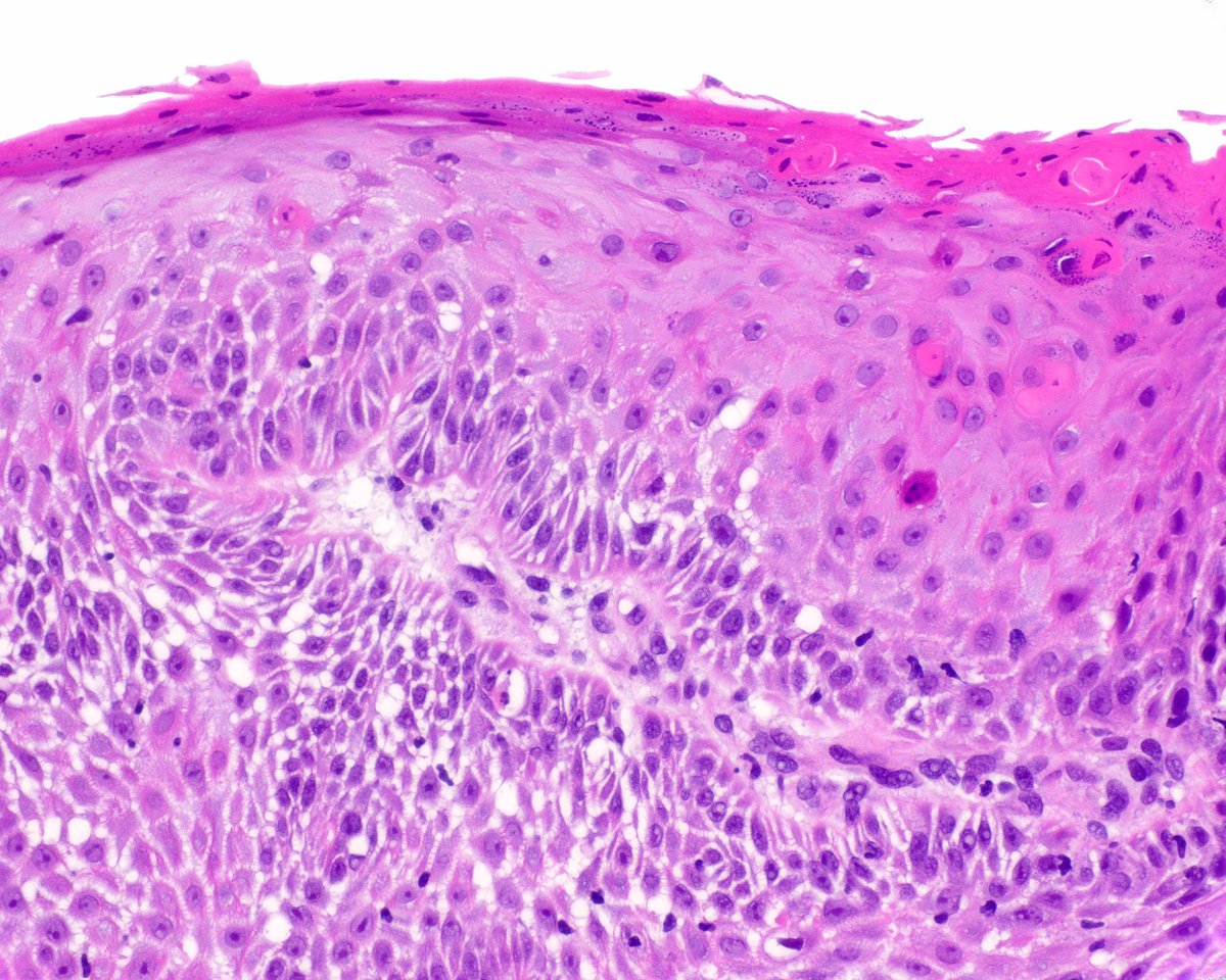LizMontgomeryMD's tweet photo. A highly differentiated esophageal squamous cell carcinoma. Tricky but diagnosable on superficial samples.  This paper has great tips extrapolated from carcinoma cuniculatum: PMID: 23348898. https://t.co/0k6CAH5g9H