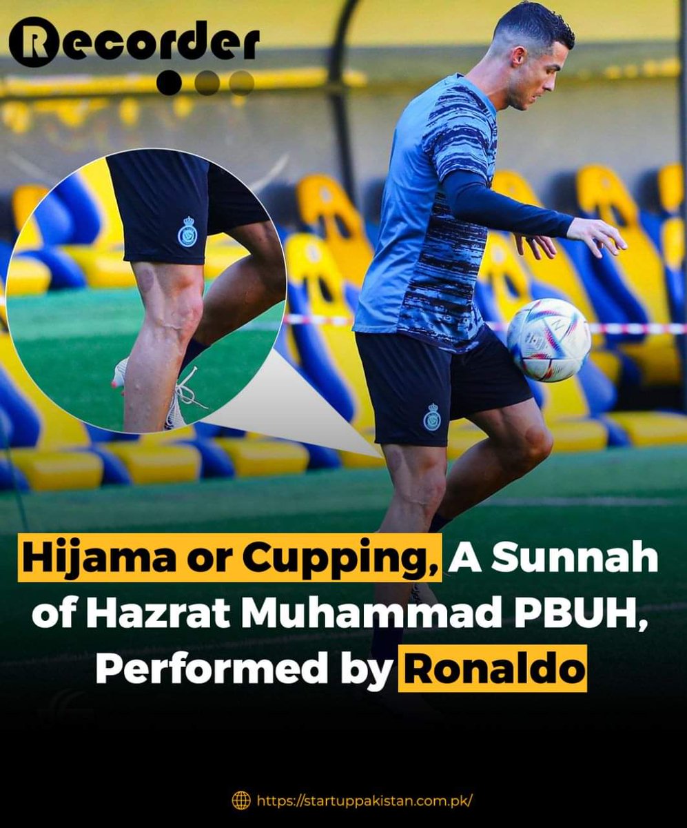 new_cupping's tweet photo. Hijama or cupping  a Sunnah of Hazzrat Muhammad PBUH 
Performed by Ronaldo 
#hijama #Ronaldo 
#Ronaldo𓃵 
@Cristiano 
03048484777 https://t.co/geXq2rJ0Wr