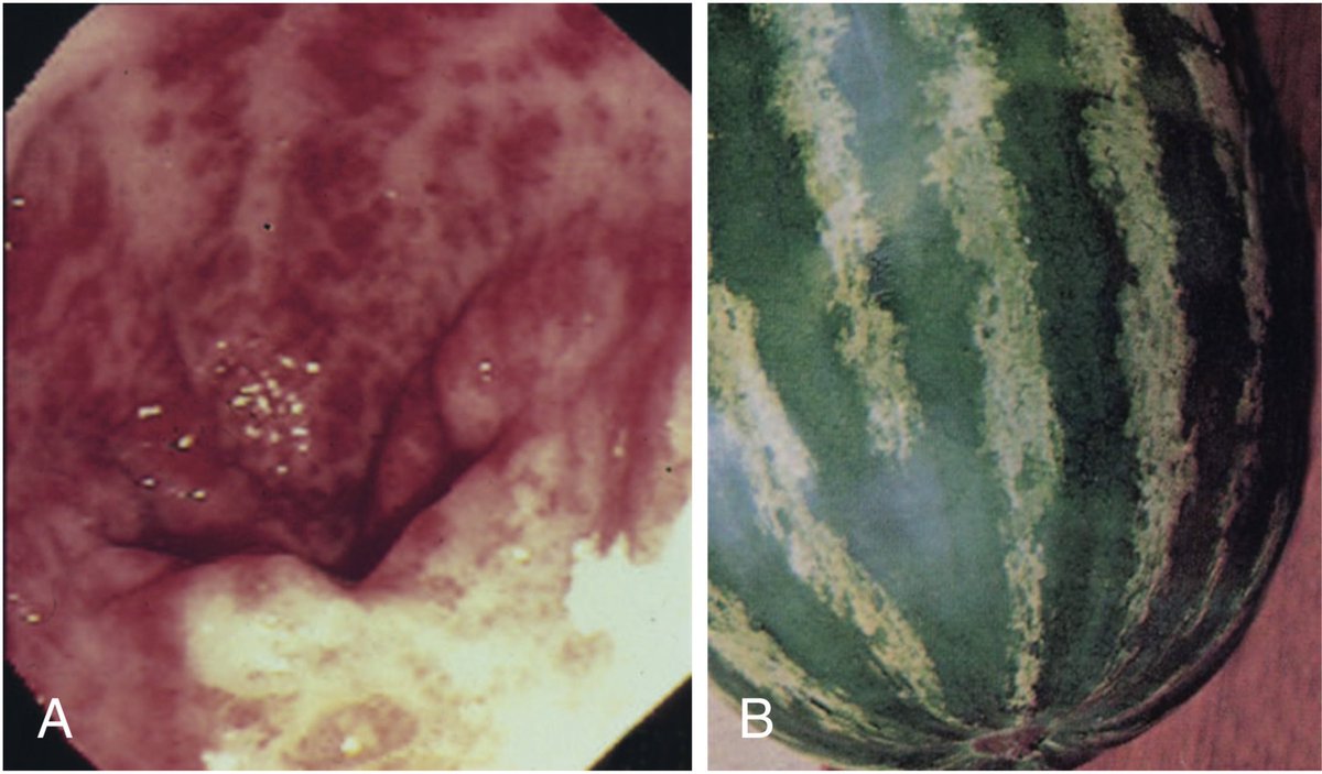 drkeithsiau's tweet photo. This is gastric antral vascular ectasia (GAVE), also known as watermelon stomach 🍉 

This is seen in 30% of patients with cirrhosis. Other associations include CKD and scleroderma.

(Original image via @walinjom) https://t.co/kOYqboBJPl