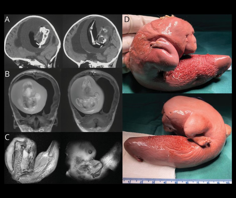 Teaching #NeuroImage: Intraventricular Fetus-in-Fetu With Extensive De Novo Gain in Genetic Copy Number bit.ly/3y3nwmg

#NeuroTwitter #NeurologyRF