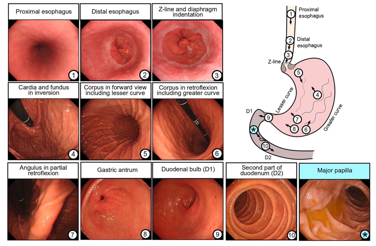 Landmarks and recommended photos to take during upper GI endoscopy 📸

dx.doi.org/10.1177/175628…