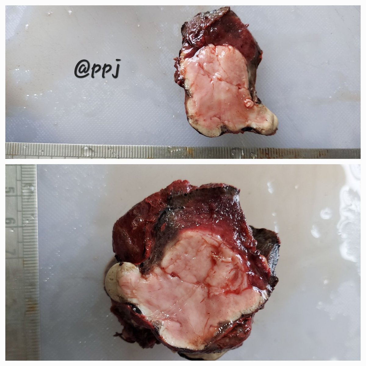 Another #OneImageDiagnosis
#macropath #grosspath #grossognosis #thyroid #endopath