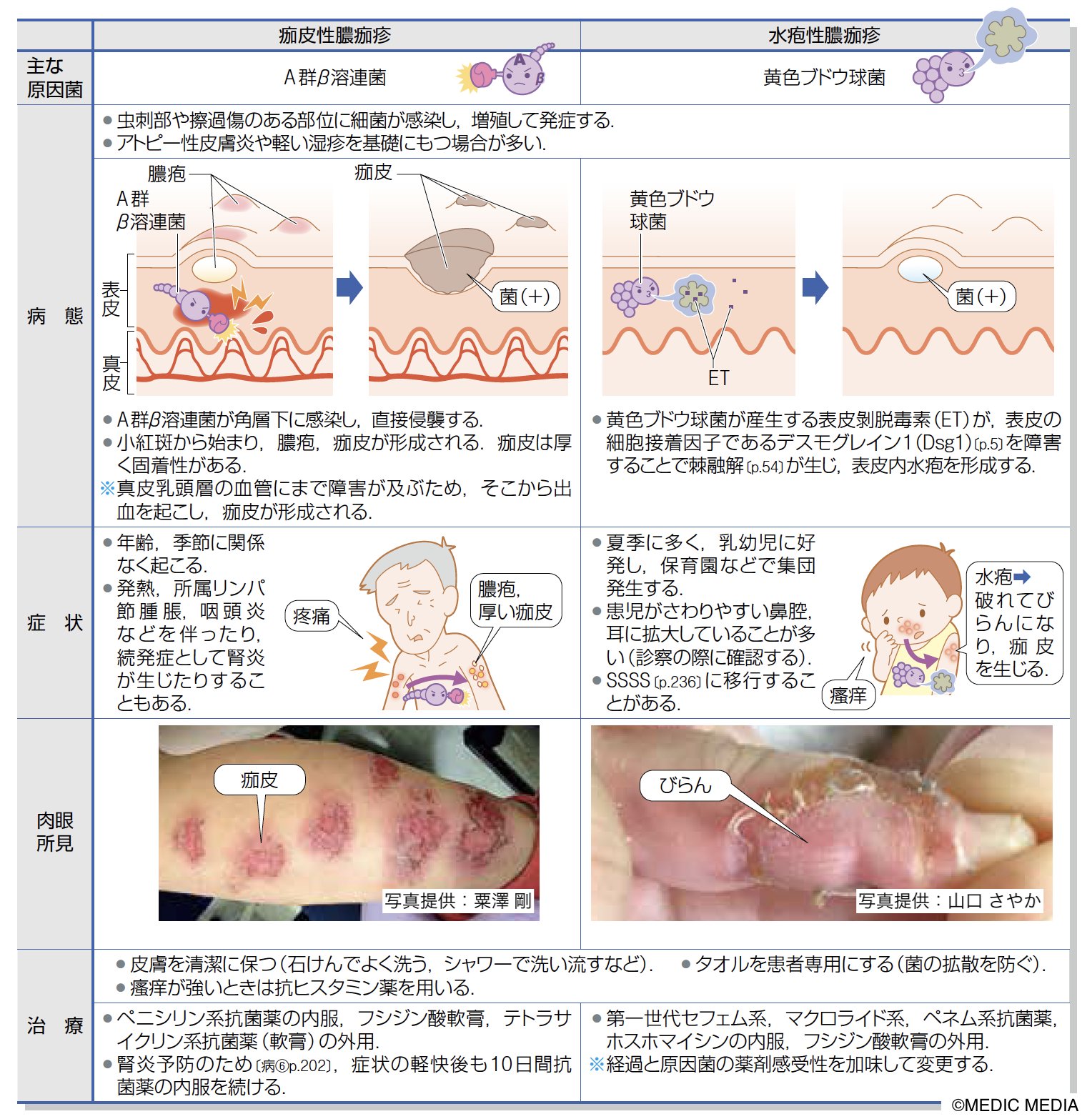伝染性膿痂疹 はどんな病気? _ 伝染性膿痂疹 大人 | ブドウ球菌性熱傷様皮膚症候群について – GAPR