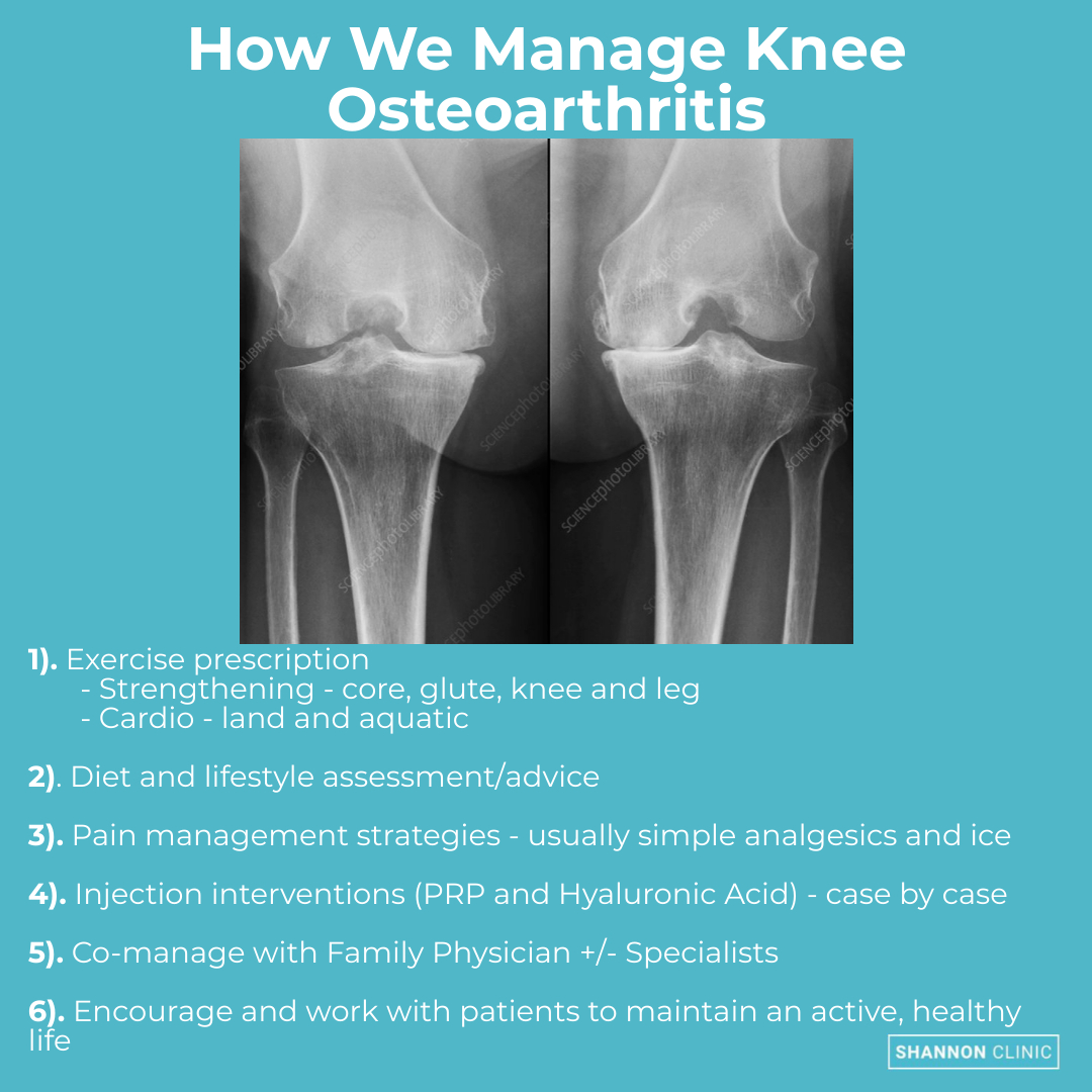 We regularly treat patients with knee osteoarthritis of varying degrees and are often asked how best to manage knee osteoarthritis. This simple slide outlines the key foundations by which we manage patients with knee osteoarthritis. #kneearthritis