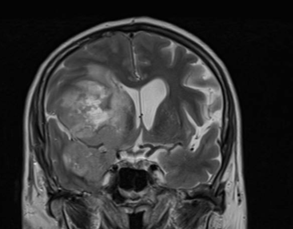carlos_adg's tweet photo. Reflexiones de la postguardia, la vida-muerte y los errores médicos. 

No dejo de pensar en a quién pertenece esta resonancia. No hace falta ser neurólogo para entender que hay una masa monstruosa donde debería haber cerebro normal. Estaba casi asintomático. https://t.co/tUoanld4e1