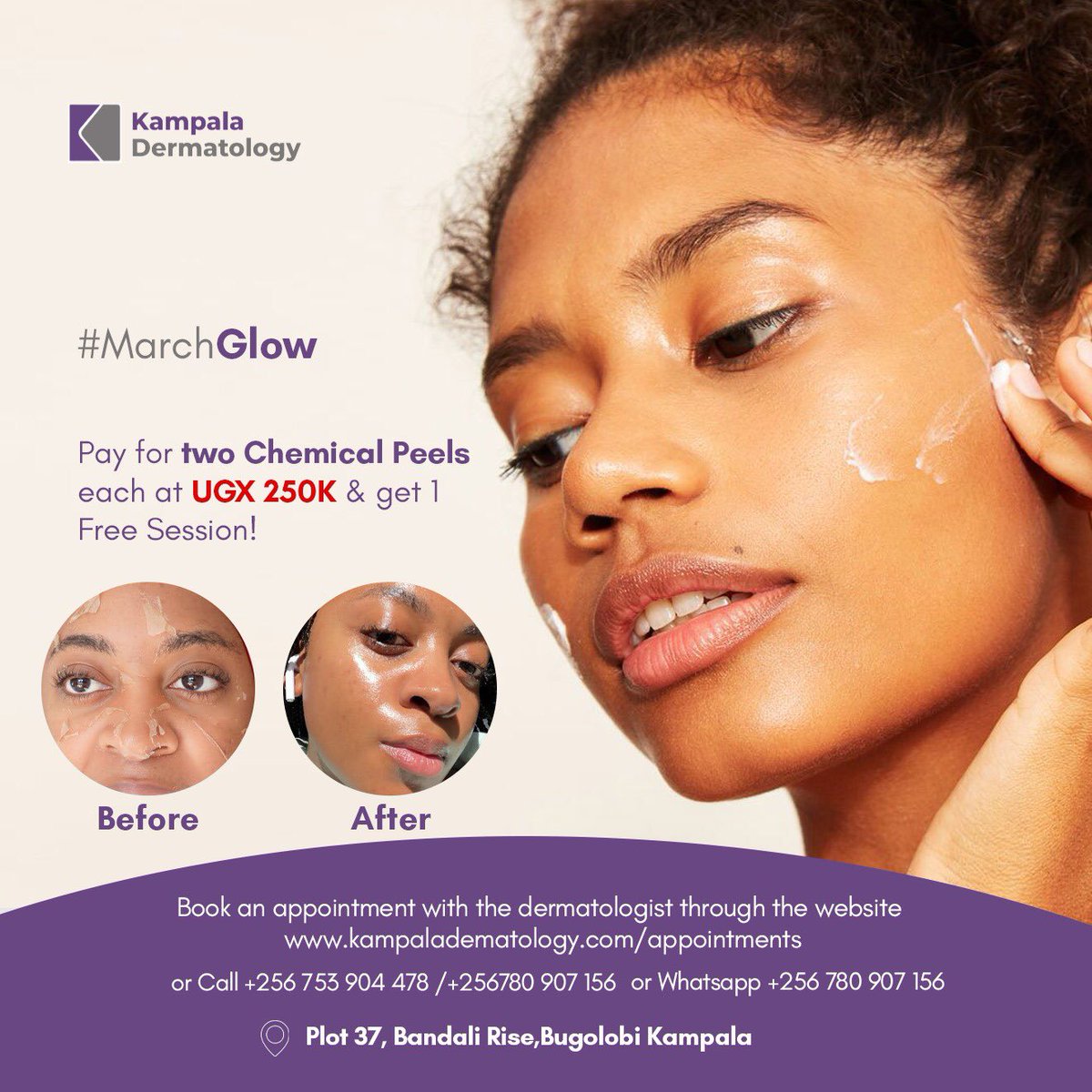kladermatology's tweet photo. Our #MarchGlow is on โจ
Pay for two Chemical Peels, each at UGX 250,000 & get one free session!
This offer is valid for the whole of March.
WhatsApp: 0780 907 156
#KlaDermatology #chemicalpeel #wrinkles #scars #BBTitansย #bbtaitans #skinglow https://t.co/UJaQExdFhZ
