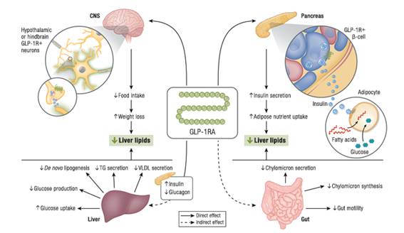 sociedadSEEN's tweet photo. 📕Glucagon-like Peptide-1 Receptor-based Therapeutics for Metabolic Liver Disease
📌Los EC en curso en personas con #EHNA definirán si los #aGLP-1 representan terapias efectivas y seguras en #EHNA
https://t.co/07vS1CIiyD
@ObesitySeen https://t.co/yDPoN81jXA