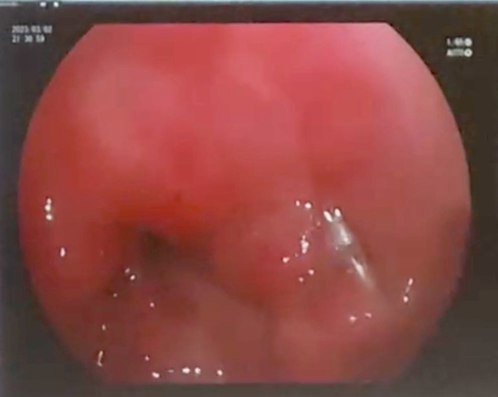 Andres Sanchez-Yague, MD, PhD, FACG, FASGE (@asyague) on Twitter photo Cierre de mucosectomia tras POEM con cinco puntos de sutura directa continua en un solo paso utilizando el sistema de sutura Apollo Cierre de mucosectomia tras POEM con cinco puntos de sutura directa continua en un solo paso utilizando el sistema de sutura Apollo