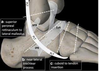 Flawless_Physio's tweet photo. Peroneus Longus pain can be located on the lateral ankle and the lateral aspect of the foot. 

Do you consider this as part of your differential for a 5th metatarsal stress injury? 🧵 1/7

https://t.co/wA9srXdQCW https://t.co/bXZi53iIYF
