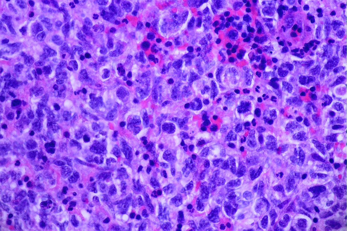 Help !
Uterine cervix, 35yo.
More pics and IHC in comment..
#gynpath #pathology