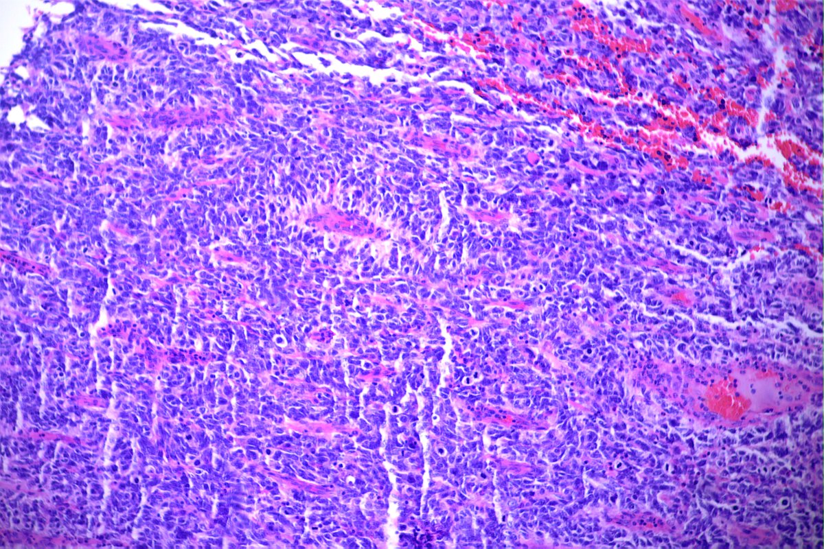 Gerônimo Jr. on Twitter "Help ! Uterine cervix, 35yo. More pics and