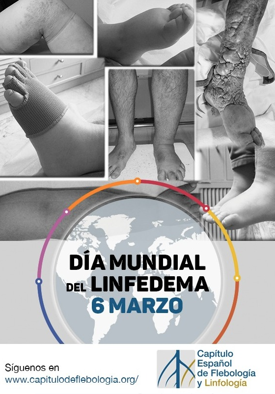 FlebologiaSEACV's tweet photo. 👨‍⚕️👩‍⚕️ Hoy 6️⃣ de marzo es el Día Mundial del Linfedema. 

👉Se trata de una patología crónica poco conocida no sólo por los ciudadanos, sino también por la mayoría de los sanitarios. https://t.co/YMgtDo0sMd
