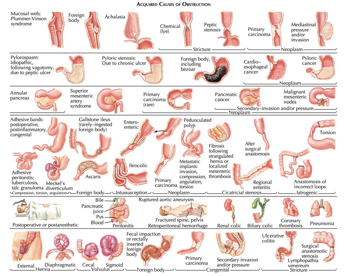 medflutter_'s tweet photo. Causes of GI Obstruction ! https://t.co/GYez4uj4vi