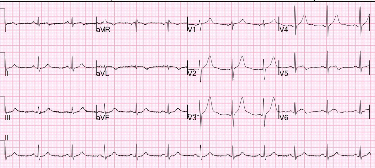 What do you think of this ECG?? 

Is this recorded during pain, or after pain resolution? 

Also, see the CT image of the heart.

hqmeded-ecg.blogspot.com/2023/03/what-d…