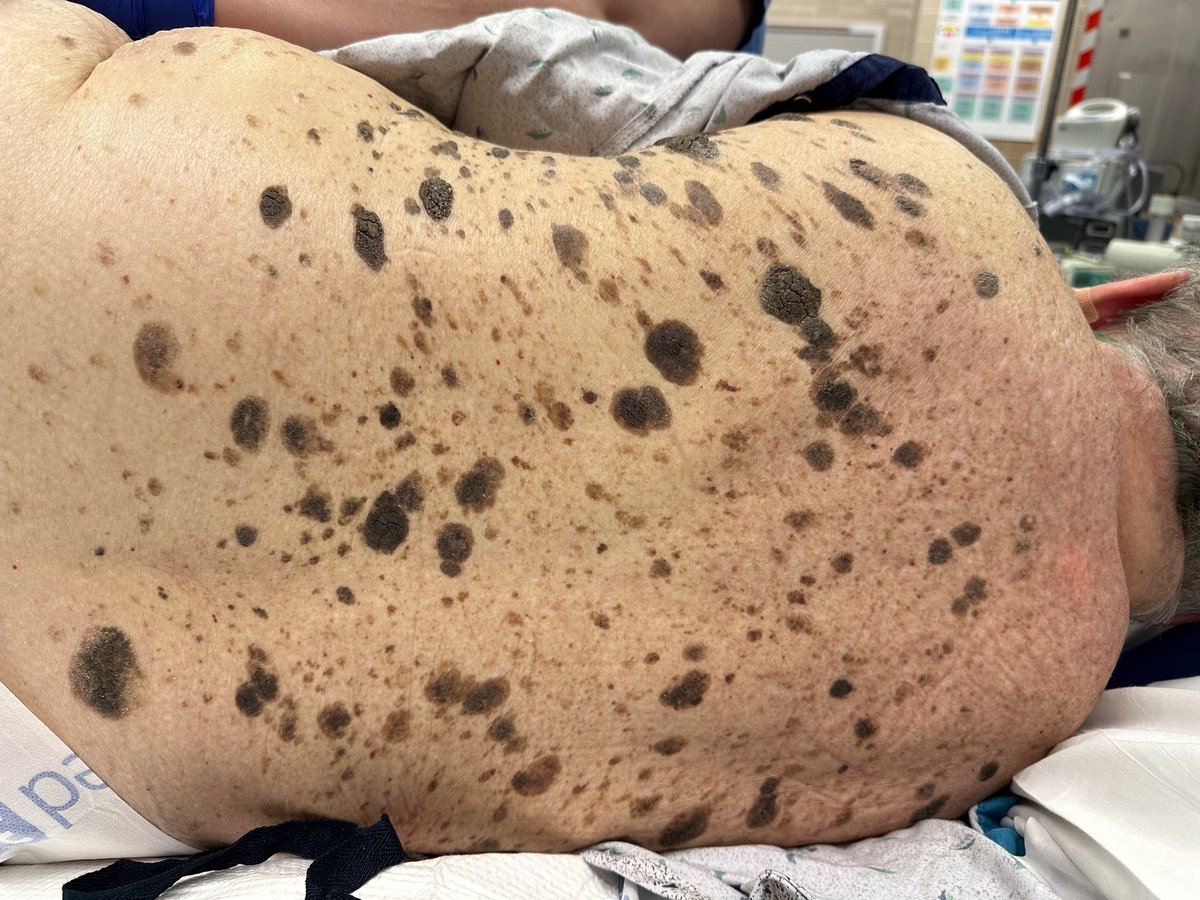 David Diehl (@daviddiehlmd) on Twitter photo The "sign of Leser Trélat", multiple seborrhiec keratoses associated with malignancy. We happened to notice this in the course of putting in a stent for obstructing colon cancer. <a href="/drkeithsiau/">Keith Siau</a> The "sign of Leser Trélat", multiple seborrhiec keratoses associated with malignancy. We happened to notice this in the course of putting in a stent for obstructing colon cancer. <a href="/drkeithsiau/">Keith Siau</a>