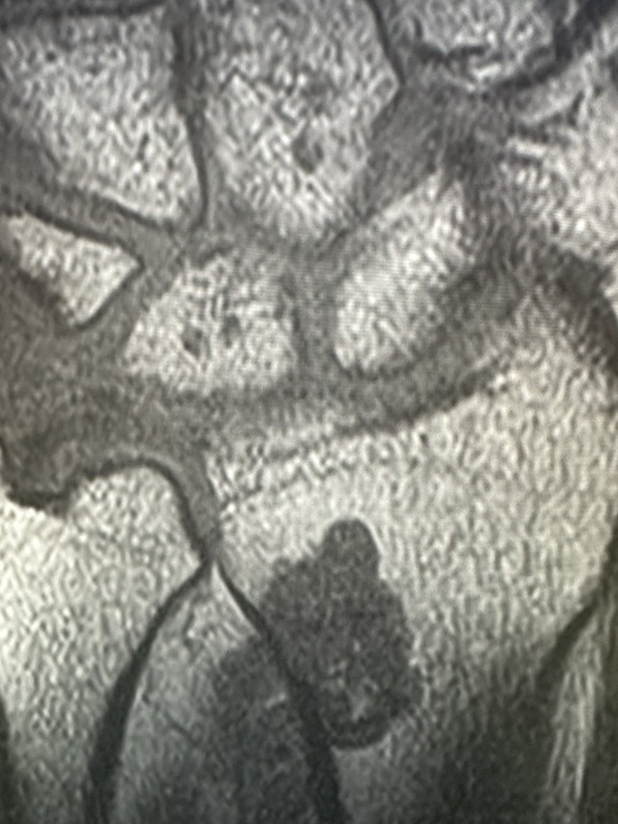 If you are reading this case on a middle aged pt but don’t have outside x-rays.you dictating this as a low-grade cartilage lesion,moving on or demanding outside x-rays obtained, loaded for interpretation bf u will interpret? outside ortho clinic