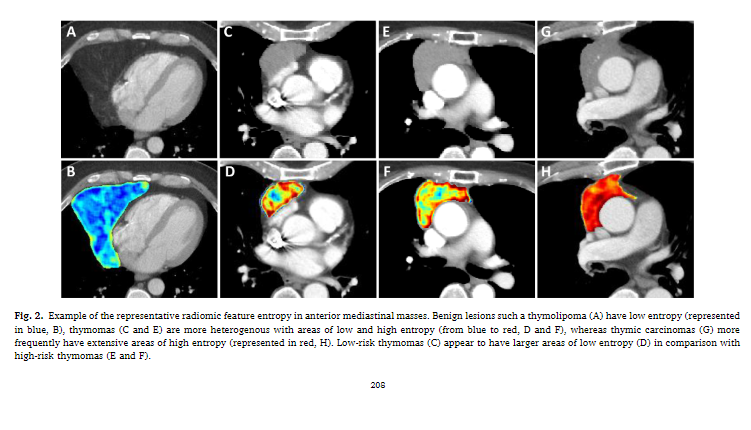 MSK_RadOnc's tweet photo. New in @LungCaJournal from the @MSKCancerCenter Radiology, surgery, #radonc teams: CT-based conventional & radiomic features with machine learning analysis could be useful for predicting pathologic diagnoses of anterior mediastinal masses. #thymomas #thmsm
https://t.co/BIfJrkJBhf https://t.co/dlbc4N4eoE