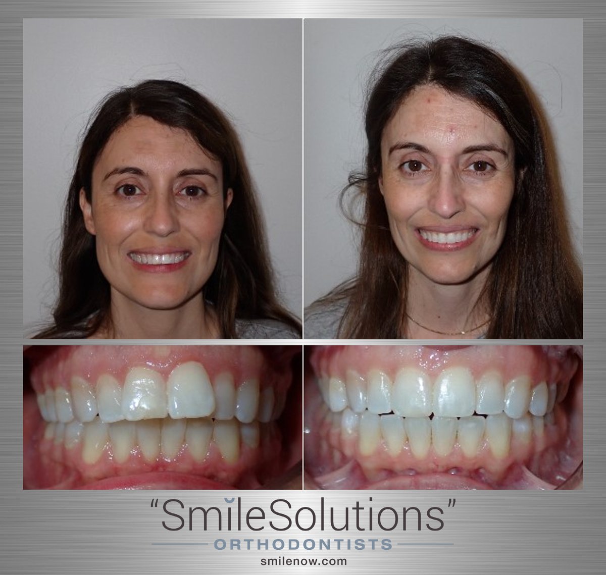 #bracesoff #orthodontistbrampton #orthodontistmississauga #smilesolutions #smilenow #bracesbrampton #bracesmississauga