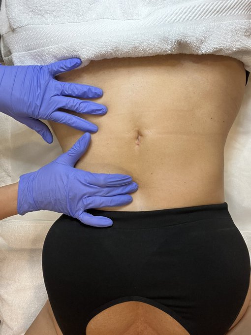 Bout to get my stomach neck and face blasted w needles. It&rsquo;s going to hurt like Fukkkkkk. But beauty<a href="/tag/keepingittight"class="tags"><span>#keepingittight</span></a><a href="/tag/keepingitright"class="tags"><span>#keepingitright</span></a><a href="/tag/16needles"class="tags"><span>#16needles</span></a><a href="/tag/m"class="tags"><span>#m</span></a>
