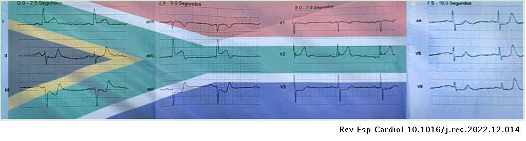 High lateral STEMI with South Africa flag sign #REC #AheadOfPrint revespcardiol.org//en-high-later…