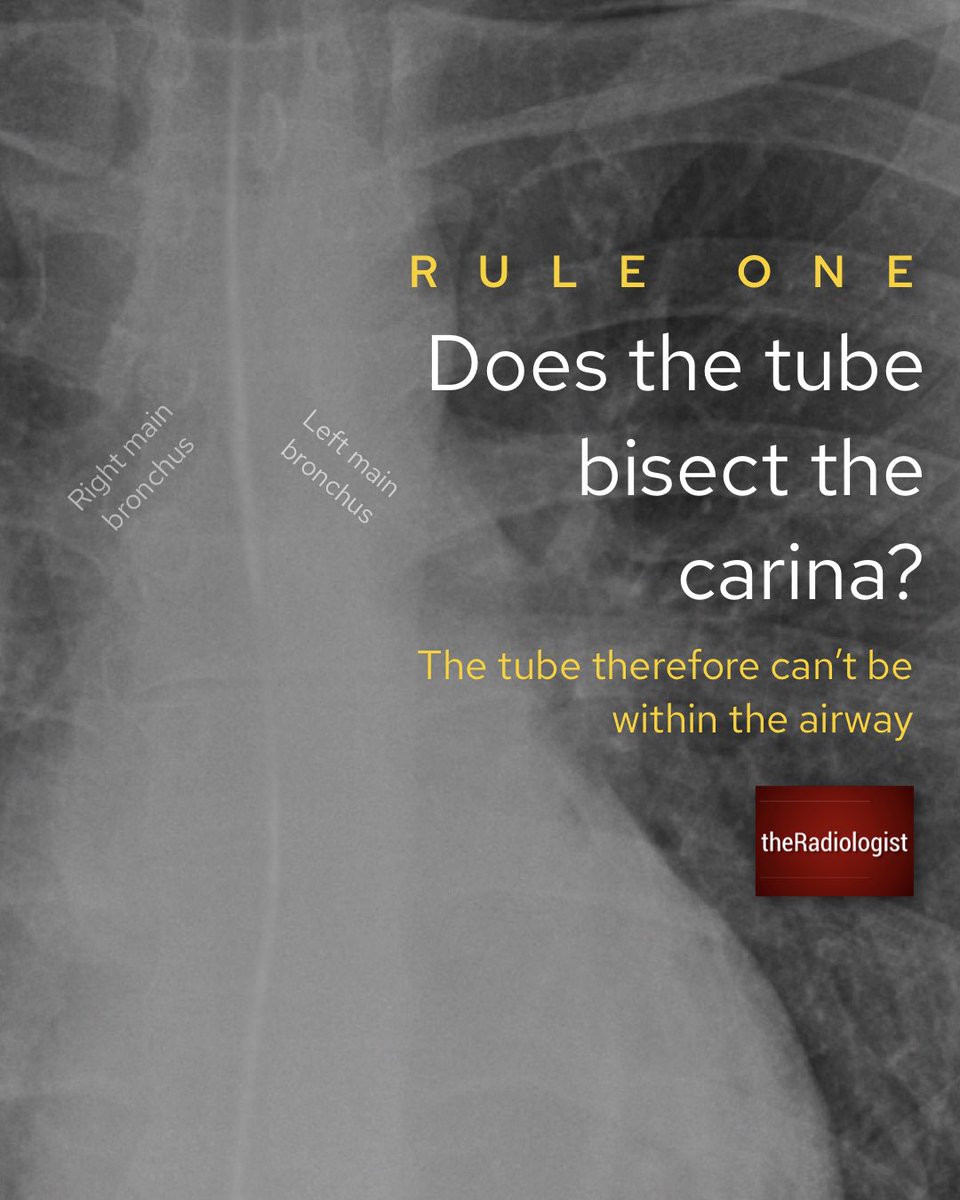 theRadiologist on Twitter "Four rules to assess nasogastric tube placement on Chest XRay"
