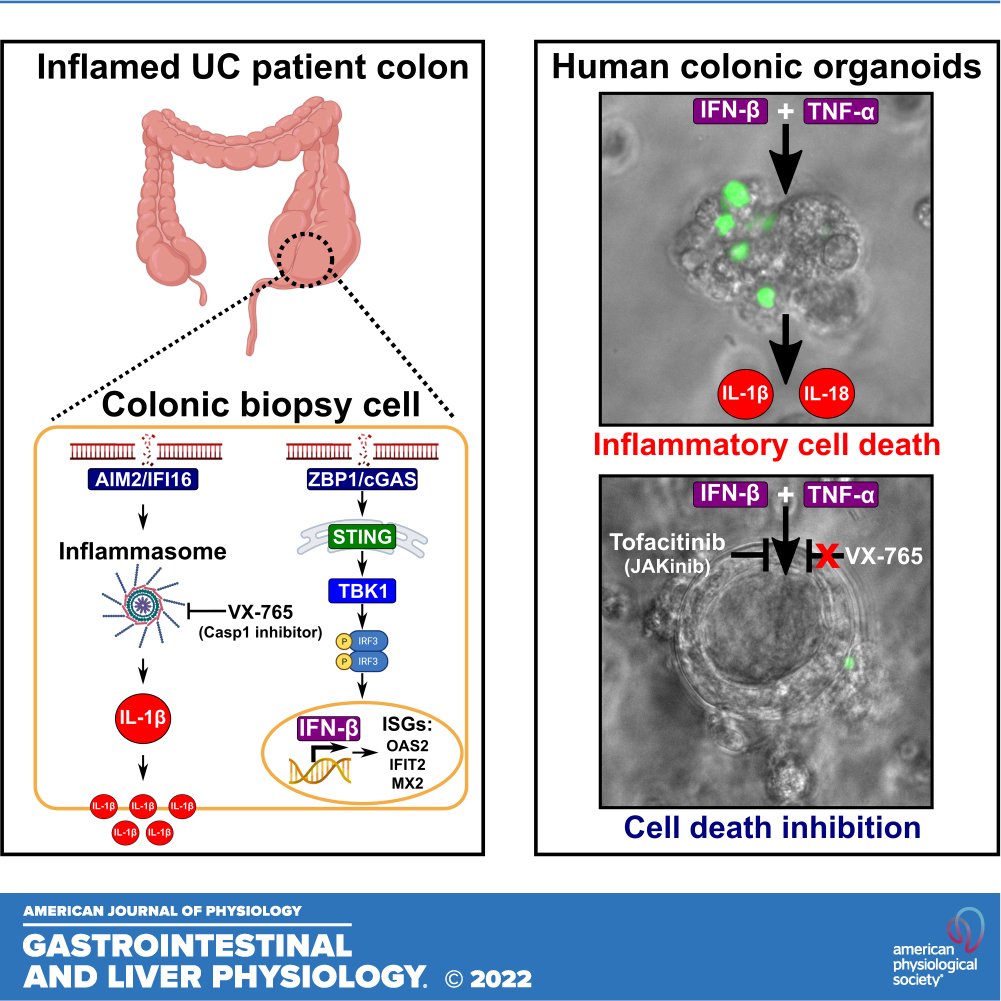 🔓#FreeArticleOfTheWeek 'DNA sensor-associated type I interferon signaling is increased in #UlcerativeColitis and induces JAK-dependent inflammatory #CellDeath in #ColonicOrganoids' by Ken Nally (@ken_nally) et al. 

🖱ow.ly/g3ir50MPPIH

@gerrymoloney #DNAsensors #ajpgi