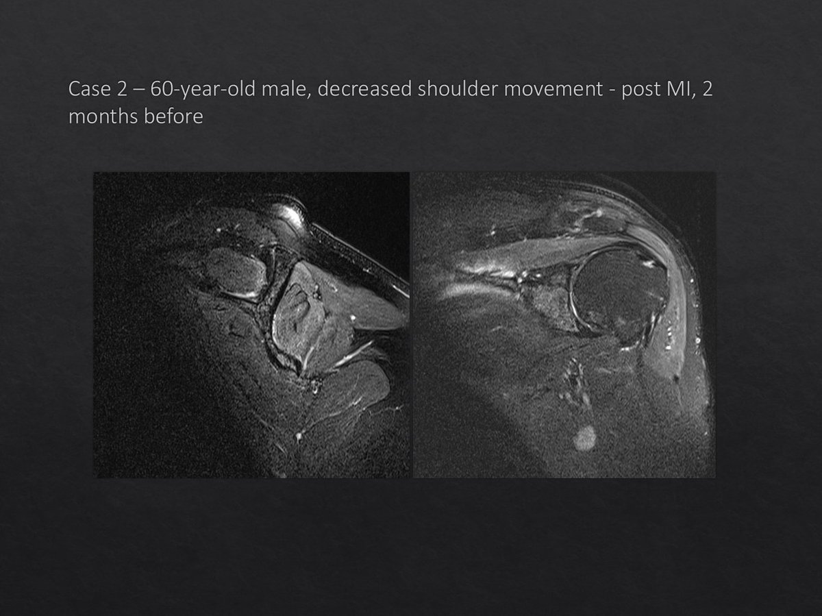 mskteachingroom's tweet photo. New post 🤩

#radfellow #radiologyfellow #radiologyresident #learningradiology #radres #mskrad #radtwitter #radiology #transformingradiology #MRI https://t.co/oZBMrwl1tX