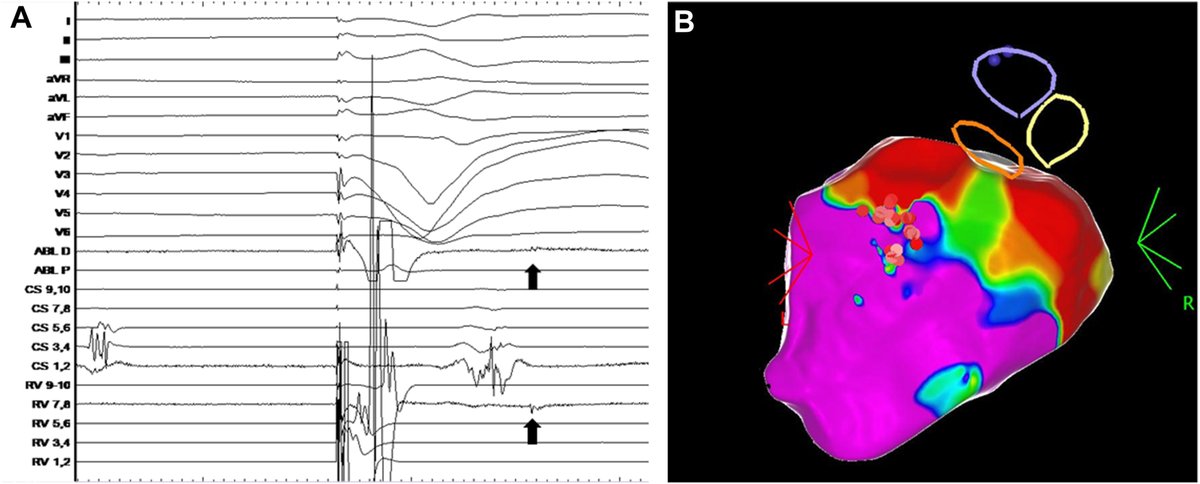 Heart Rhythm Case Reports tweet media