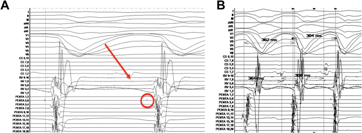Heart Rhythm Case Reports tweet media