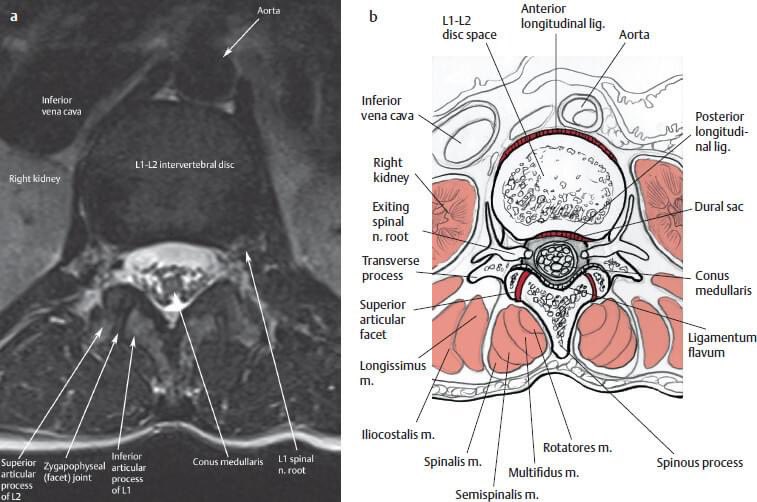 asterkawi's tweet image. Save this images!

Axial and sagittal lumbar MRI views, showing normal anatomy. 

From my favorite book: Khanna, MRI Essentials for the Spine Specialist (chapter 4).

YouTube education: youtube.com/channel/UC6A5C…

#LumbarMRI #MRI #backpain #PainPhysician