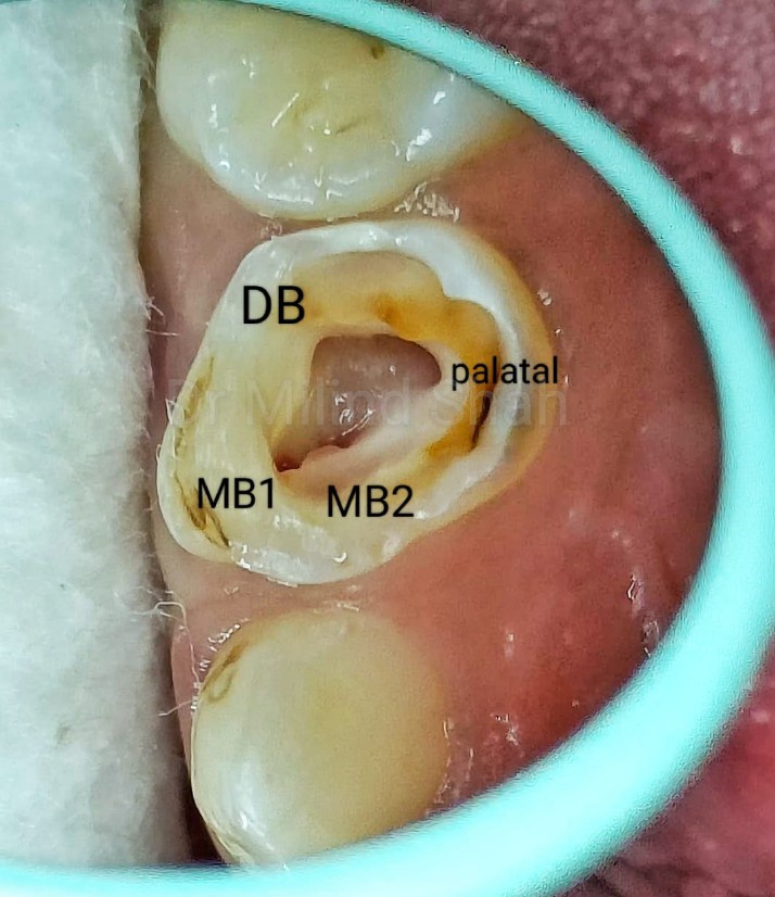 Just for a change something different.
Mb2 canal in upper first primary molar.
4.5 yr old child managed chairside.
#behaviourmanagement  #pediatricdentistry  #dentistry