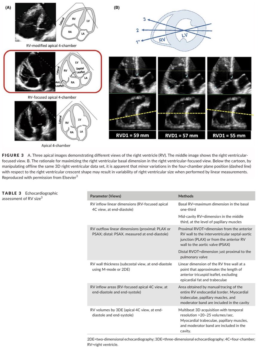 “Echocardiographic assessment of the right ventricle in the current era: Application in clinical practice.” #CriticalCare #3Dechocardiography, #Echofirst  #echocardiography, #rightventricle #ThePeoplesVentricle #PoCUS #FOAMcc #FOAMed #FOAMus #MedEd 🔗 onlinelibrary.wiley.com/doi/10.1111/ec…