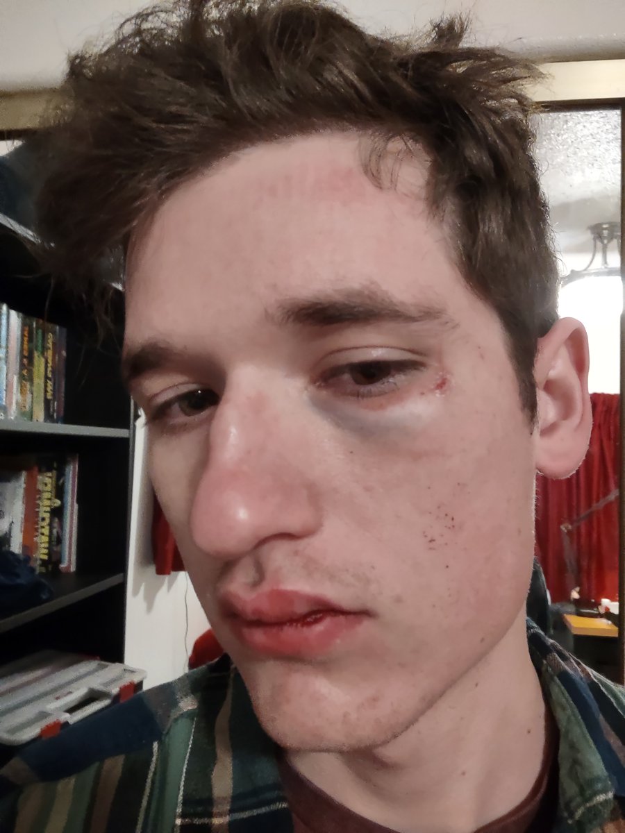 bondy_bradley's tweet photo. Well, I got assaulted on the MAX. Some meth head bashed my head with a big fucking rock. I'm fine. I went to the ED and they said I don't got a concussion. Just got some lacerations and a black eye. My face fucking hurts tho. https://t.co/XeA00WQxo3