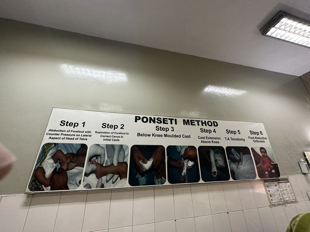 Ponsetti method #ctev #orthopaedics