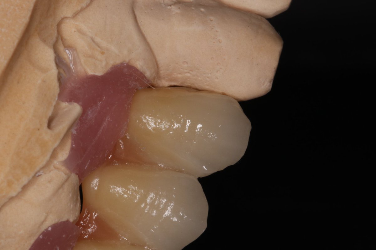 alphadental1980's tweet photo. Daily work ๐ฉโ๐ฌ๐ฆท
#dentaldigitallaboratory #dentaltechnician #dubaidental #ceramics #zirconia #dubaidentist https://t.co/oTtSHfJ8hB