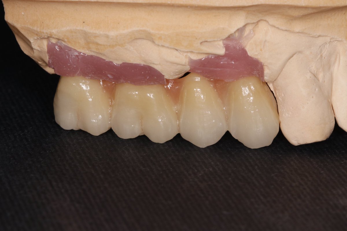 alphadental1980's tweet photo. Daily work ๐ฉโ๐ฌ๐ฆท
#dentaldigitallaboratory #dentaltechnician #dubaidental #ceramics #zirconia #dubaidentist https://t.co/oTtSHfJ8hB