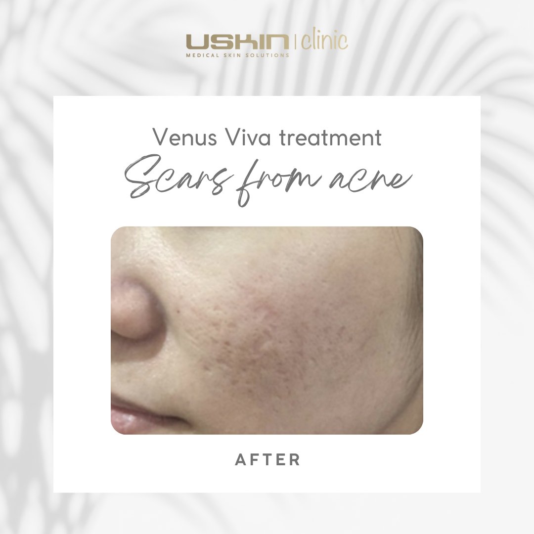 Ook voor acné littekens hebben wij de oplossing! Swipe naar links voor het prachtige resultaat na 3 Venus Viva behandelingen.

Venus Viva stimuleert de aanmaak van collageen en elastine, werkt op huidverstrakking en de structuur van de huid.

#uskintheclinic #huidverbetering