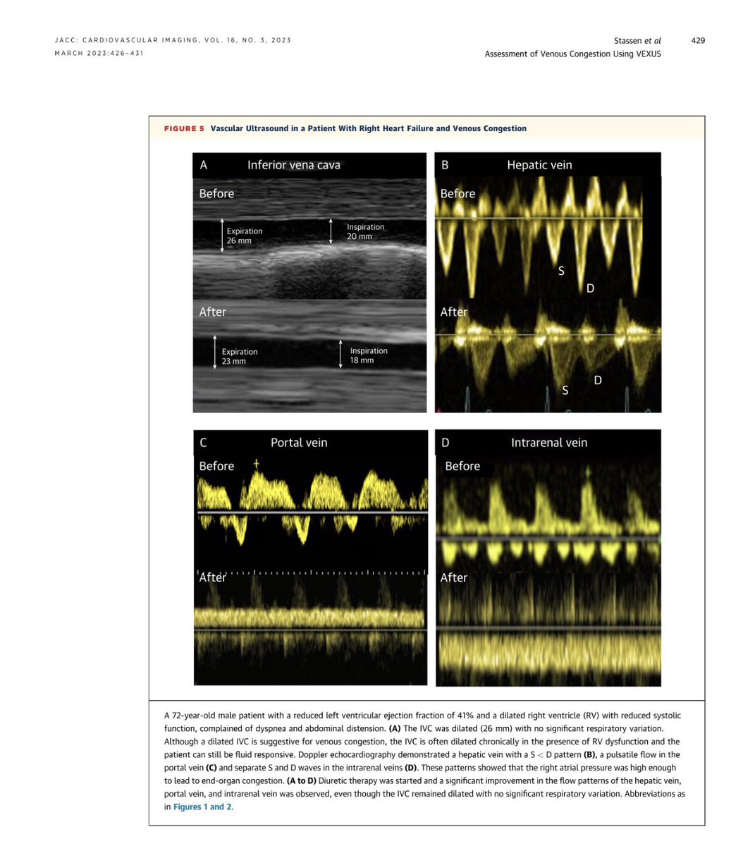 Jan Verwerft (@verwerftjan) on Twitter photo After learning a lot on #VExUS from intensive care and nephrology on #SoMe
The portal vein, for me, was a revelation 🪄
▶️ very feasible
▶️ often reclassifies RAP
▶️ useable also in AF
Case based learning by ⭐️#JanStassen ⭐️in this image vignette <a href="/JACCJournals/">JACC Journals</a> After learning a lot on #VExUS from intensive care and nephrology on #SoMe
The portal vein, for me, was a revelation 🪄
▶️ very feasible
▶️ often reclassifies RAP
▶️ useable also in AF
Case based learning by ⭐️#JanStassen ⭐️in this image vignette <a href="/JACCJournals/">JACC Journals</a>