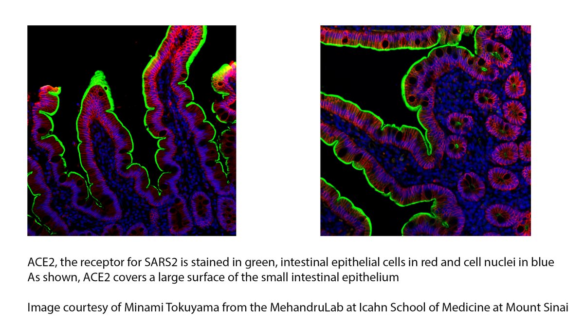 Mehandru Lab @MountSinai (@mehandrulab) on Twitter photo Stunning images from Minami Tokuyama <a href="/MinamiTokuyama/">Minami Tokuyama</a> <a href="/mehandrulab/">Mehandru Lab @MountSinai</a>
from her gastroenterology <a href="/AGA_Gastro/">Gastroenterology</a> paper pubmed.ncbi.nlm.nih.gov/32980345/ showing ACE2 covering the small intestinal surface in an article in the NY times today!
nytimes.com/2023/03/07/hea… Stunning images from Minami Tokuyama <a href="/MinamiTokuyama/">Minami Tokuyama</a> <a href="/mehandrulab/">Mehandru Lab @MountSinai</a>
from her gastroenterology <a href="/AGA_Gastro/">Gastroenterology</a> paper pubmed.ncbi.nlm.nih.gov/32980345/ showing ACE2 covering the small intestinal surface in an article in the NY times today!
nytimes.com/2023/03/07/hea…